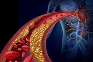 Cholesterol And Heart Diseases Cholesterol And Heart Diseases